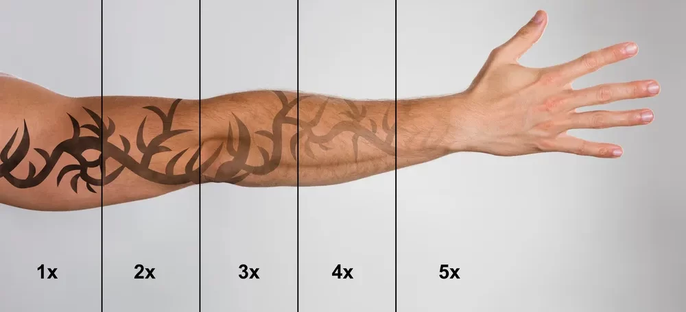 How Long Does Laser Tattoo Remov e1676196664602